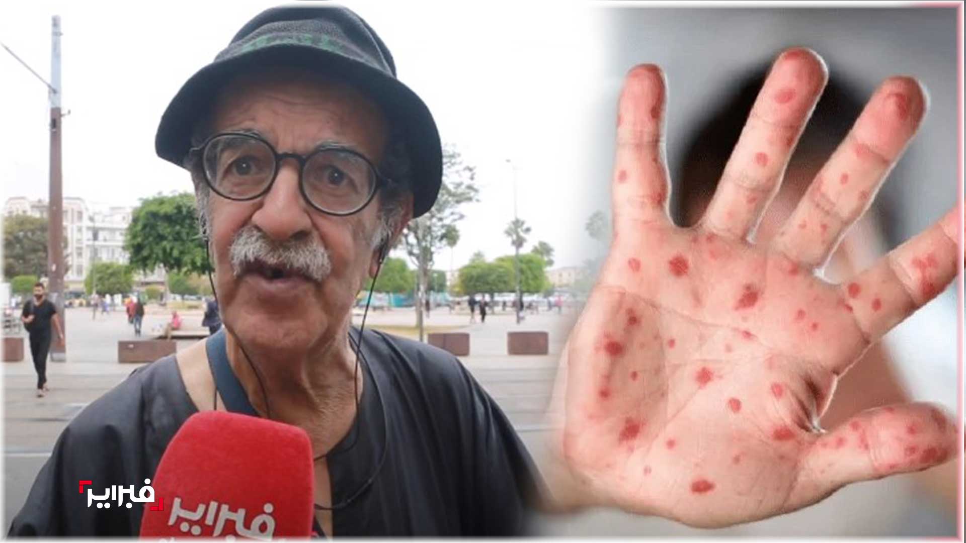 جدري